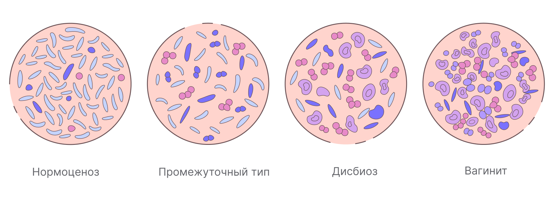 Анаэробный дисбиоз. Дисбиоз. Симптомы нарушенной микрофлоры влагалища.